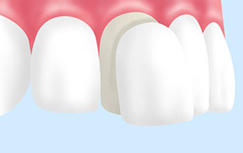 セラミックなど薄い素材で歯を審美的に改善